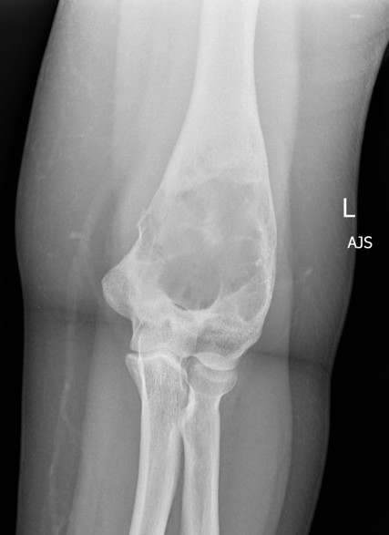 FD Humerus 1