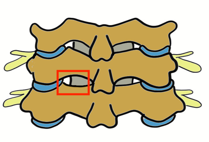 Foraminotomy