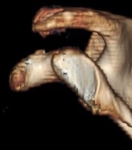Glenoid