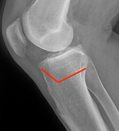 Biplanar medial osteotomy