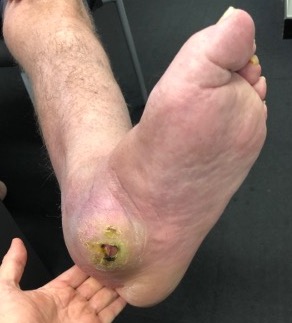 Charcot