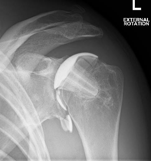 Humeral resurface loose