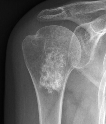 Humerus enchondroma