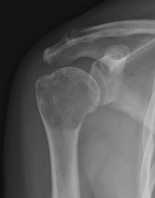 Humerus lytic met