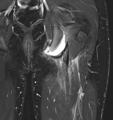 Ischial tuberosity avulsion 3