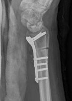 radial short