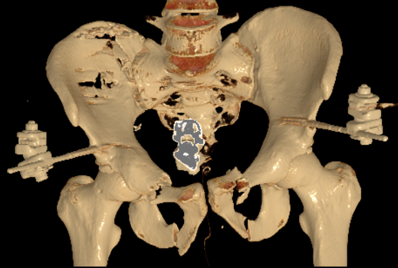 Vert shear inital management