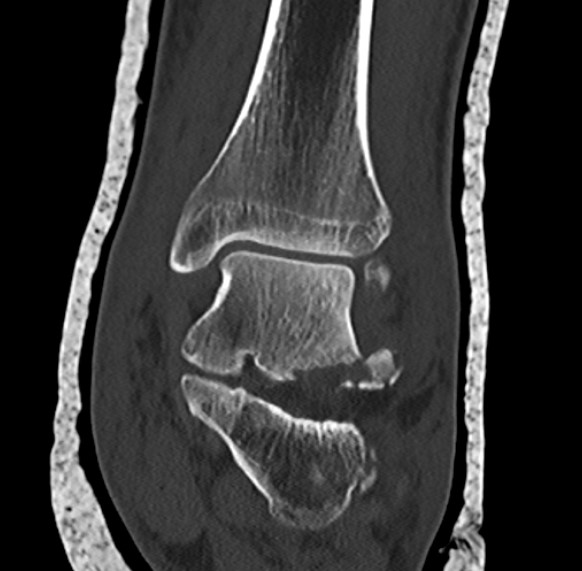 lateral process comminuted