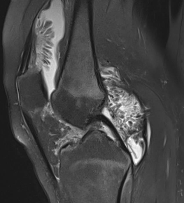 arborescens MRI