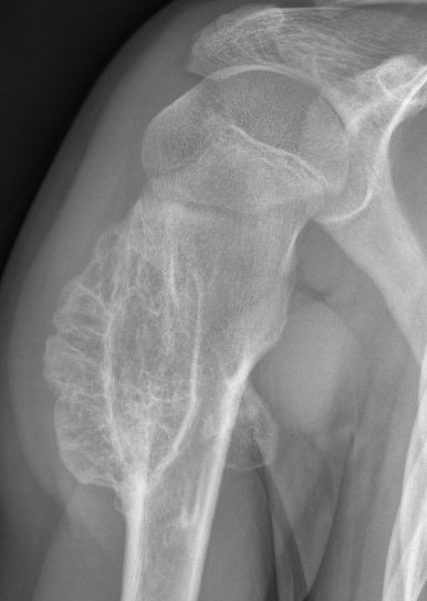 Osteochondroma shoulder