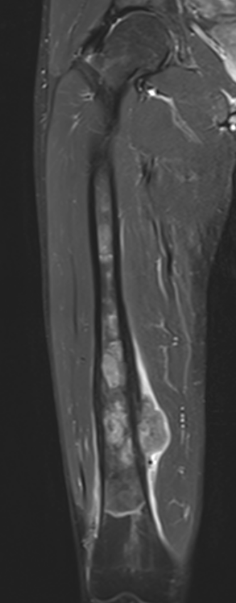 MRI OS Femur 2