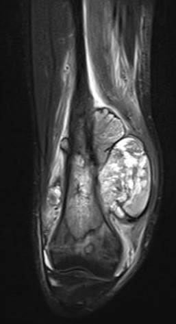 OS MRI Femur