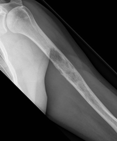 Osteosarcoma humerus