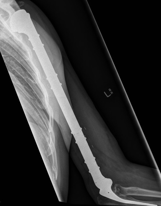 Humerus megaprosthesis 2