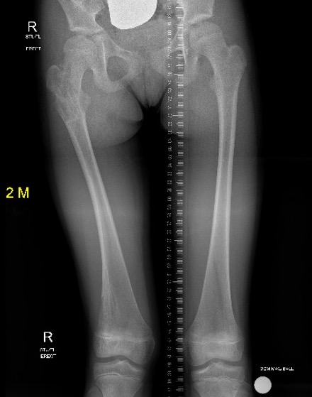 Olliers femur