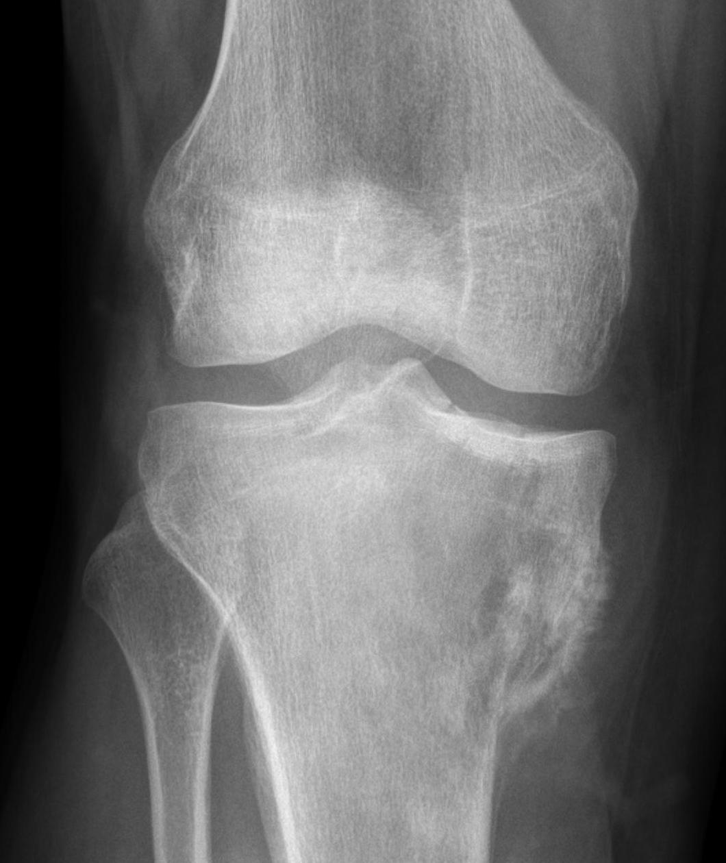 Osteosarcoma tibia 2