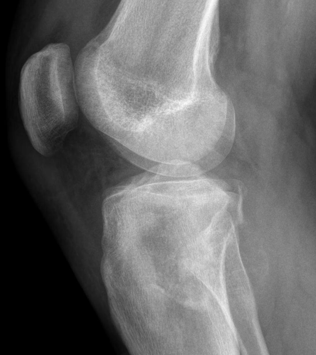 Osteosarcoma tibia 1