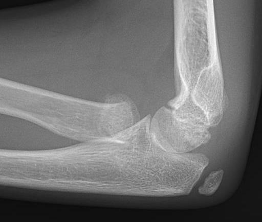 Radial neck