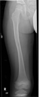 femur