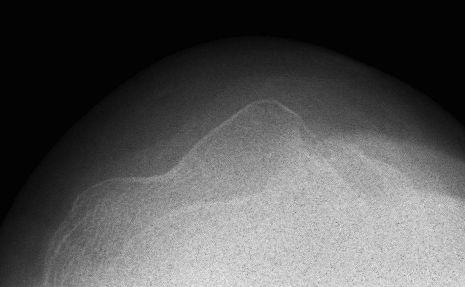 patella dislocation