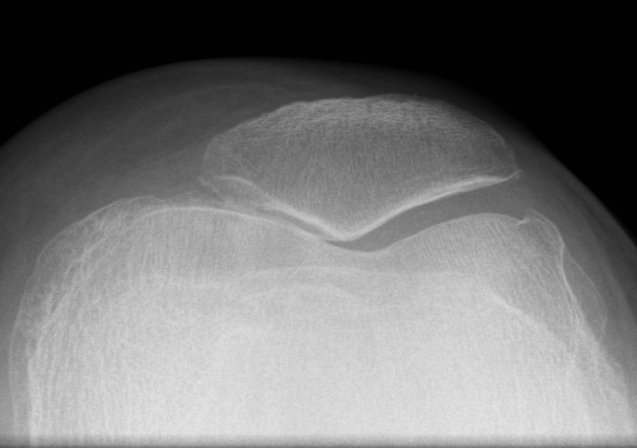 Patella OA