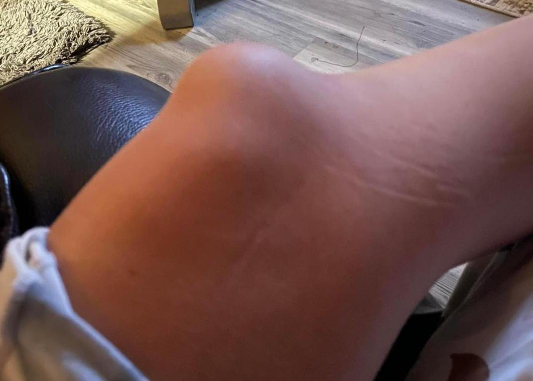 patella dis