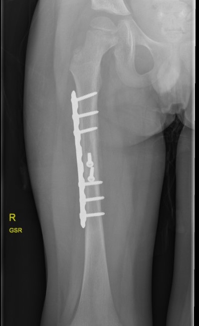 femur plate
