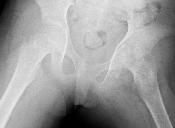 Septic arthritis