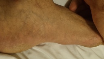 fibroma