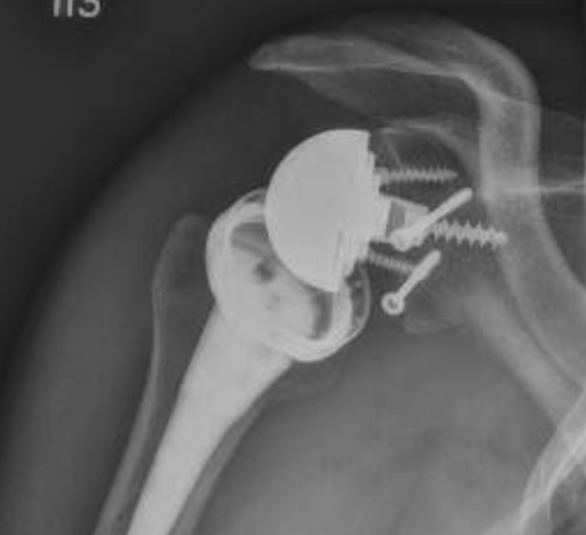 Glenoid fracture
