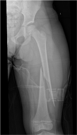 femur