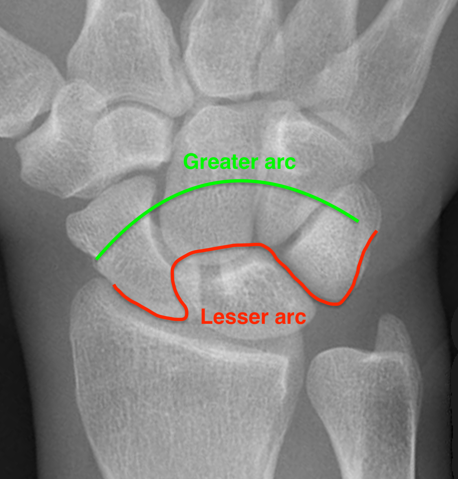 Perlunate