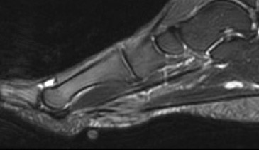 fibroma