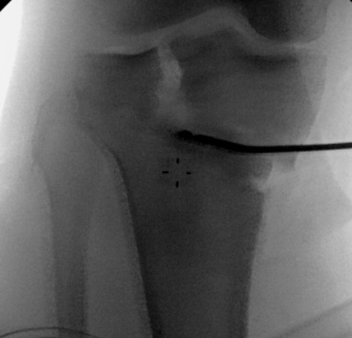 HTO intraarticular fracture