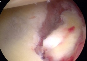 glenoid