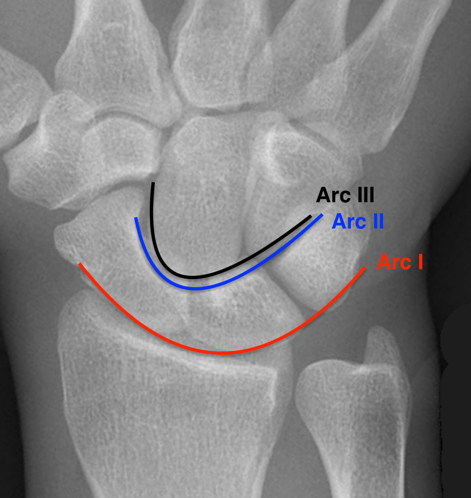 Gilula arc