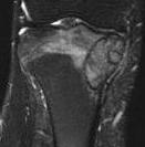 Chondroblastoma MRI