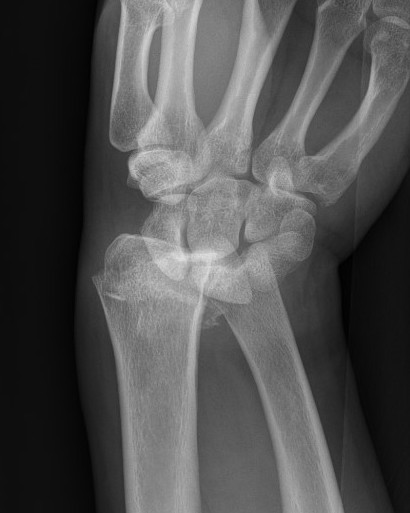 RC dislocation