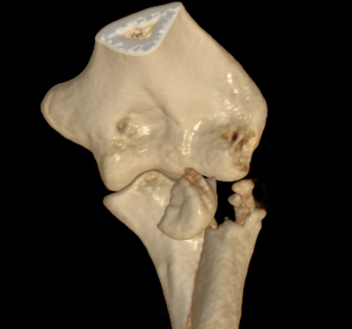 Radial head fracture