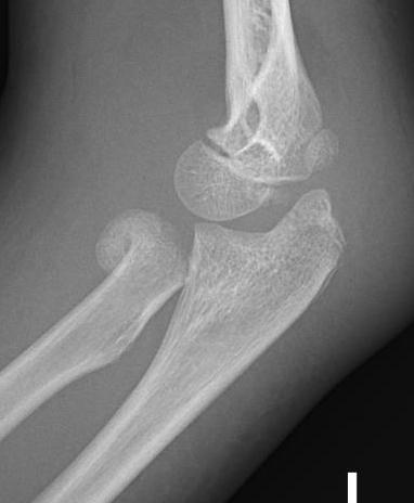 Radial neck