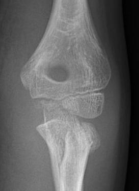 Radial neck