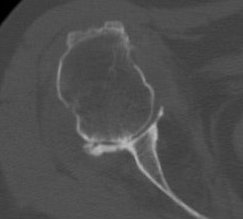 Rheumatoid shoulder CT