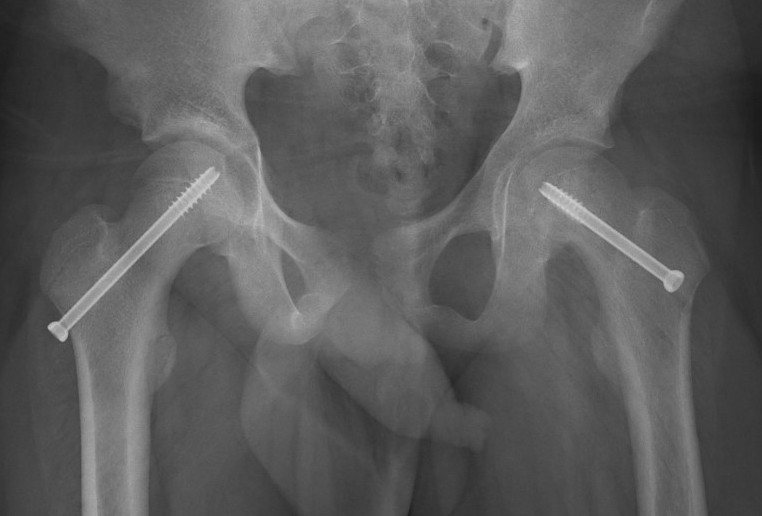 Bilateral screws