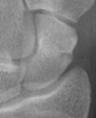 scaphoid