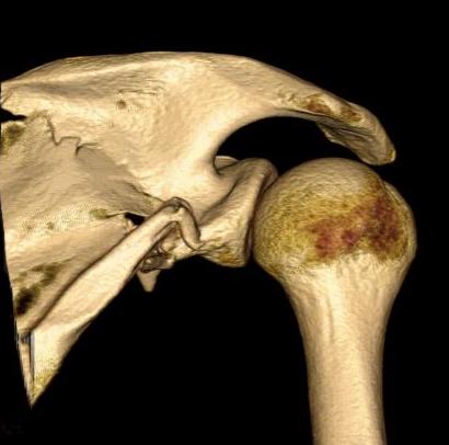 scapula