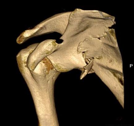 Scapula