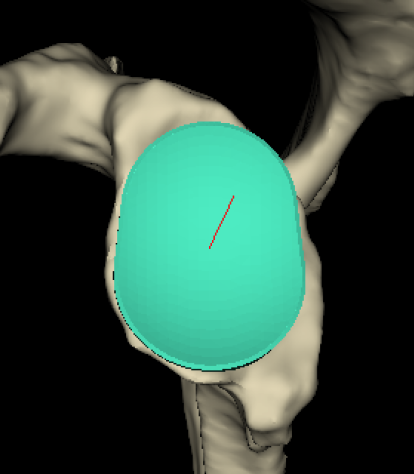 Glenoid template 1