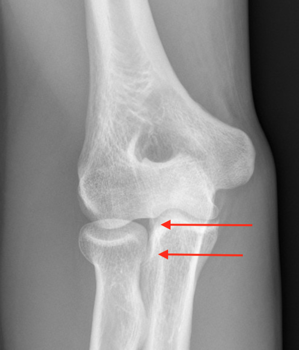 Lesser sigmoid notch