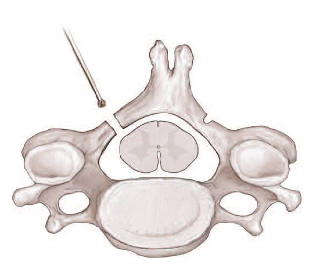 Laminoplasty 1