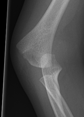 Distal physeal